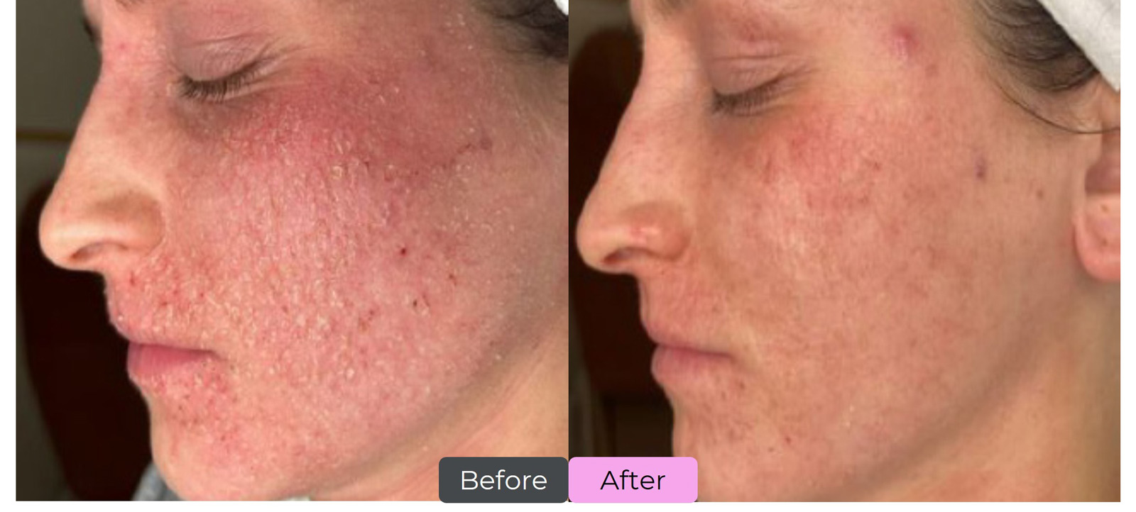 Inflammatory Acne, after 16 treatments